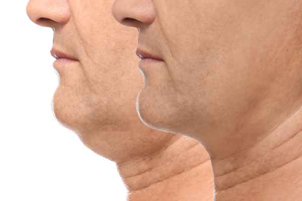 HIFU - Breakthrough in Anti - ageing 2 hifu results Littlehampton