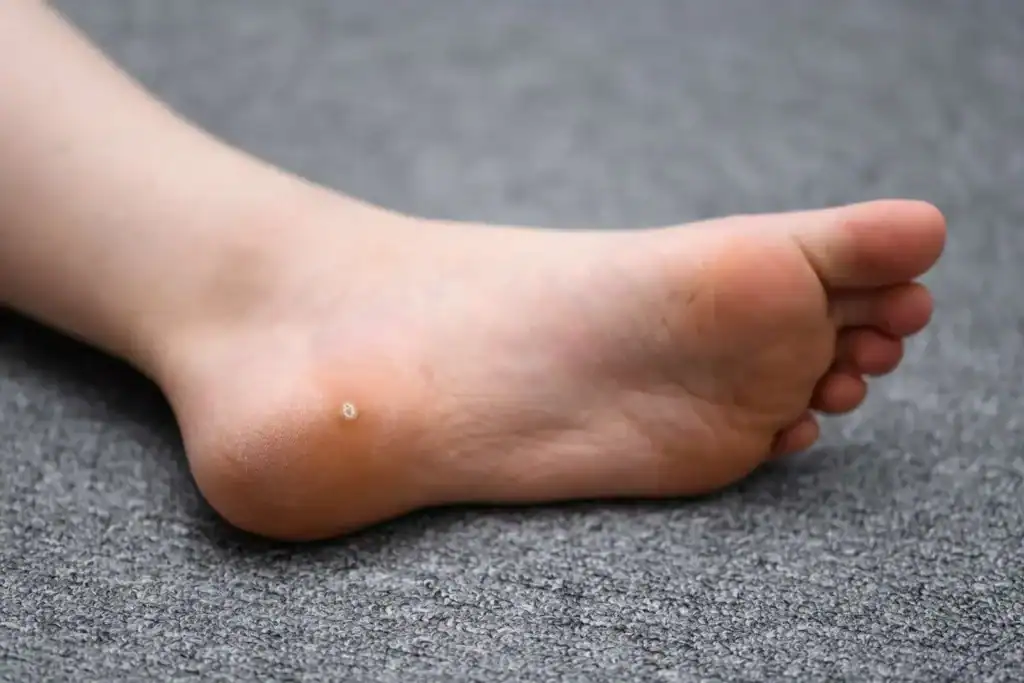 Cryotherapy For Warts And Also Verrucas 2 Image of verruca on the bottom of the foot that able to be treated with Cryotherapy Littlehampton