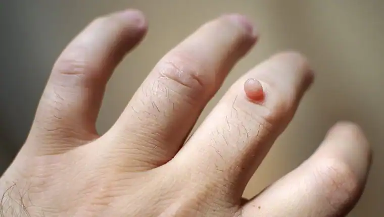 Image of blemish that Cryotherapy Littlehampton can remove with Lipo 360.