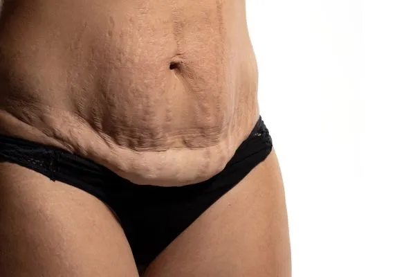 The Science of Skin Tightening 1 The science behind skin tightening Littlehampton picture of a woman's sagging skin on the stomach